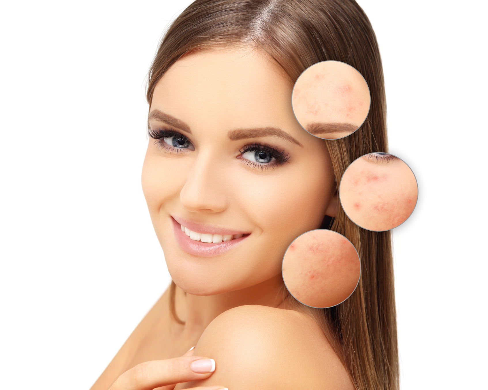 Post-Acne Marks,Acne Scars